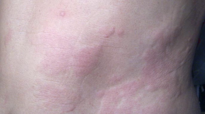 chronic urticaria and hives